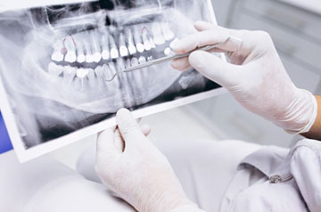 root-canal-therapy